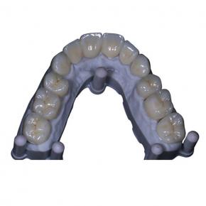 Zirconia Crowns and Bridge