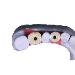 Single Crown Implant