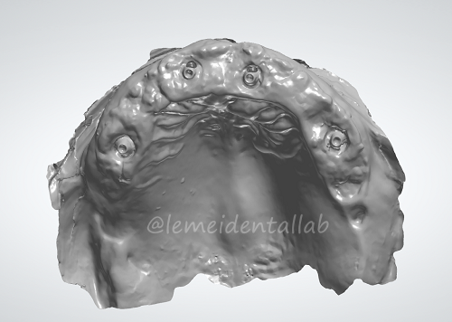 1764994127194547.png Edentulous Case_副本.png