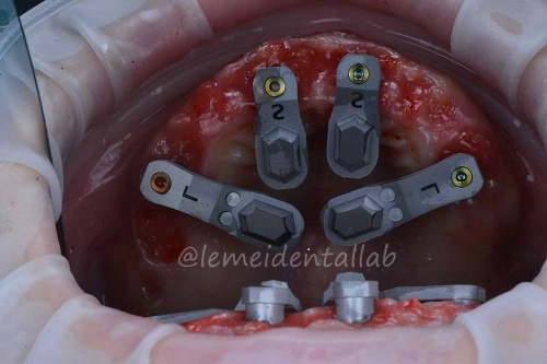 1764994171862813.jpg TruAbutment ioConnect_副本.jpg